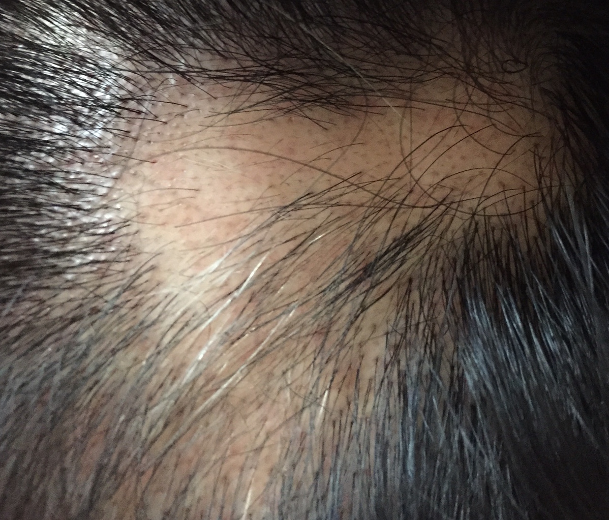 summary_alopecia-08-3