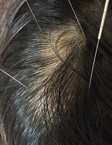 summary_alopecia-12-4