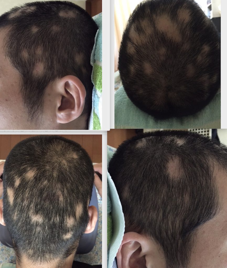 KY治療後多発型円形脱毛症