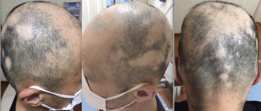 円形脱毛症,京都市,ms