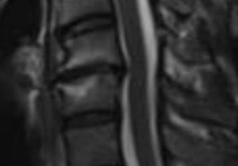 頚椎症, 脊柱管狭窄症