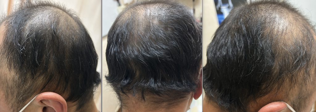 円形脱毛症, 京都府,大阪府MS