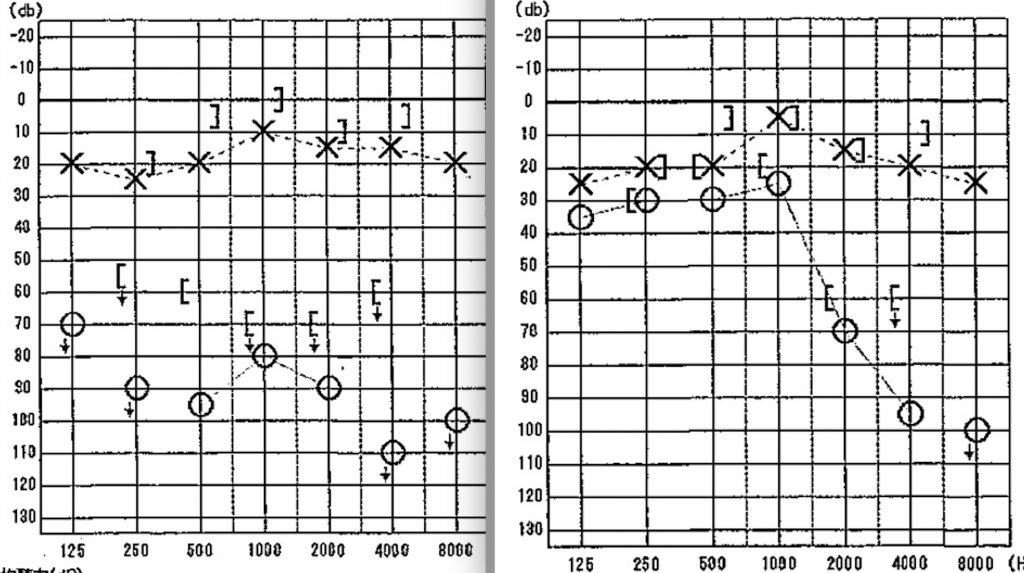 外リンパ瘻（がいりんぱろう）術後,京都市,SY