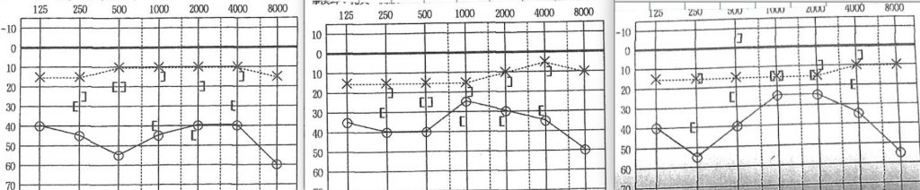 難聴,耳鼻科,京都市,TA
