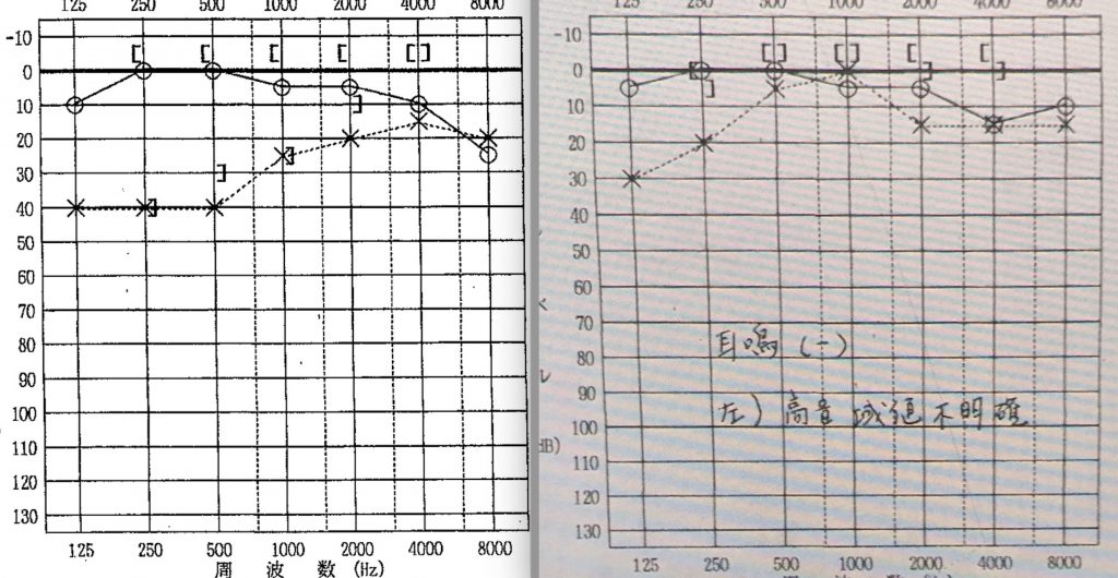 突発性難聴, 京都市TH