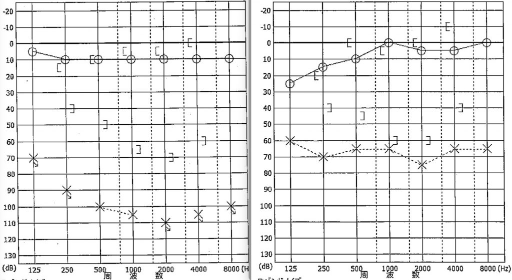 外リンパ瘻手術後,京都市,HA