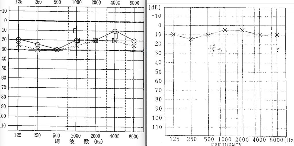 耳鼻科,,難聴,京都市、こもり,閉塞感,FK