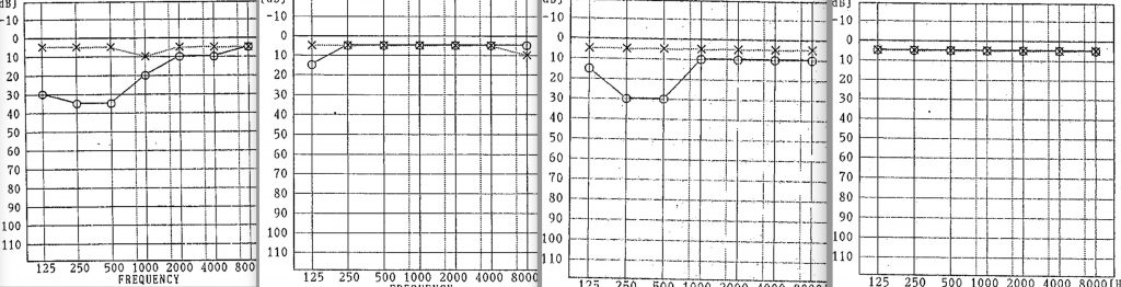 突発性難聴,京都市、MK
