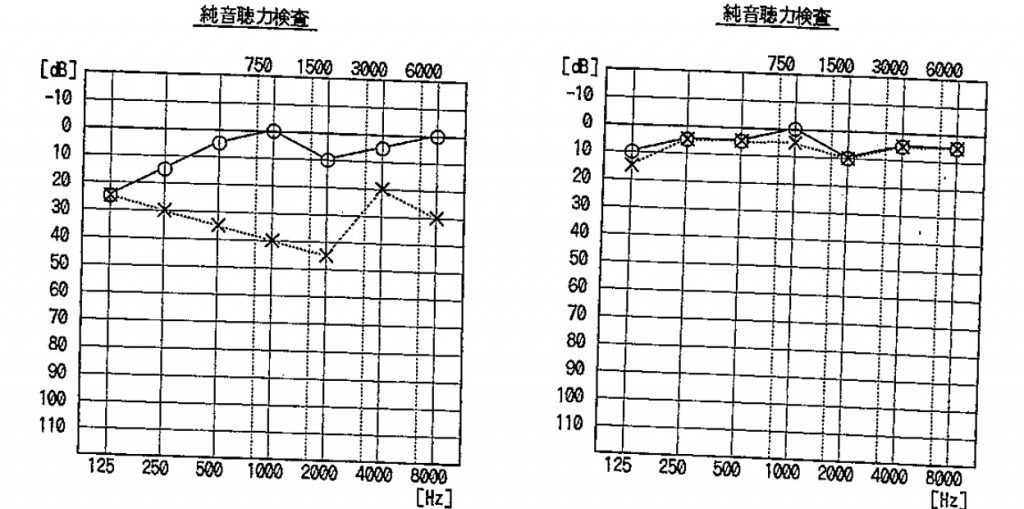 京都市,耳鼻科,難聴