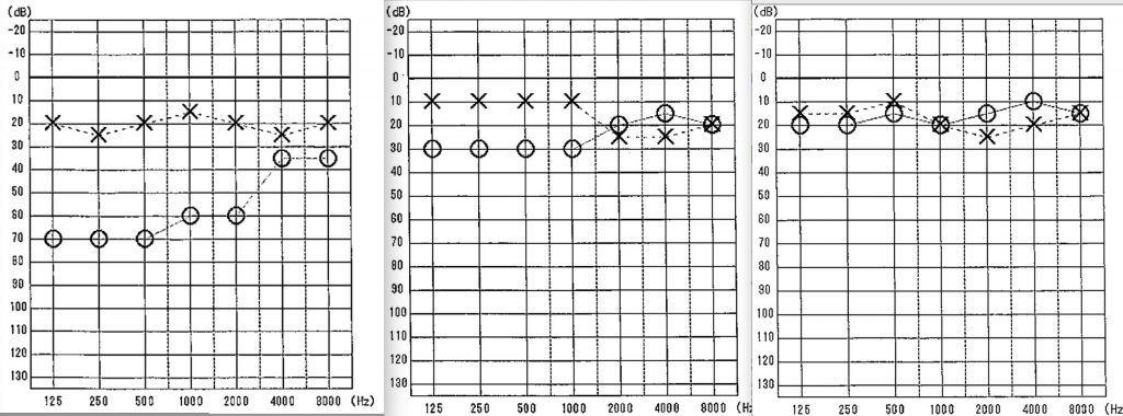 耳鼻科,京都市,難聴