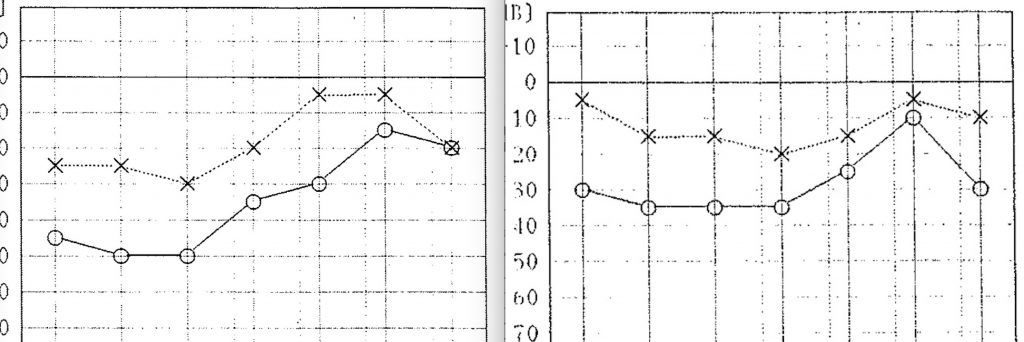 耳鼻科,京都市,難聴