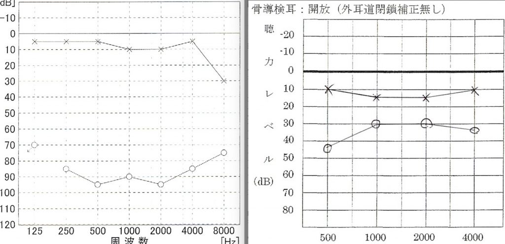 突発性難聴,京都市,NK