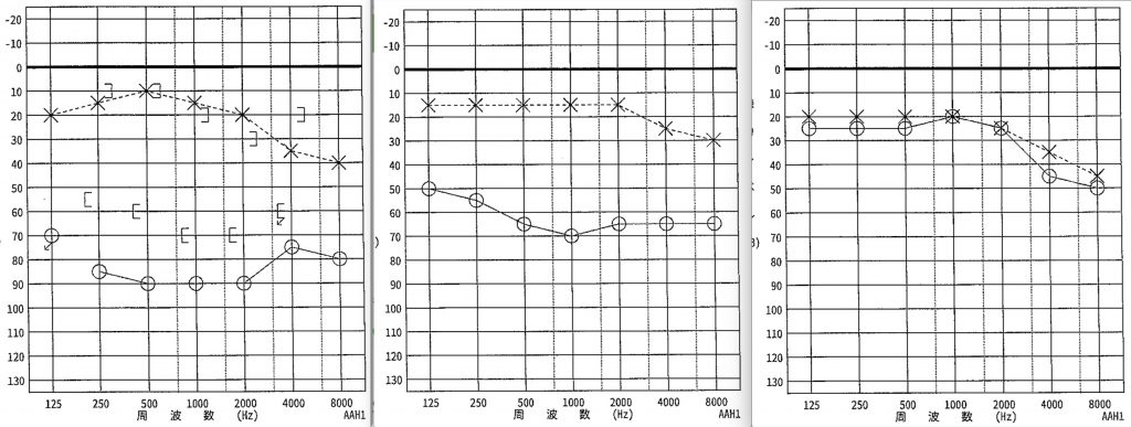 突発性難聴,京都市,耳鼻科