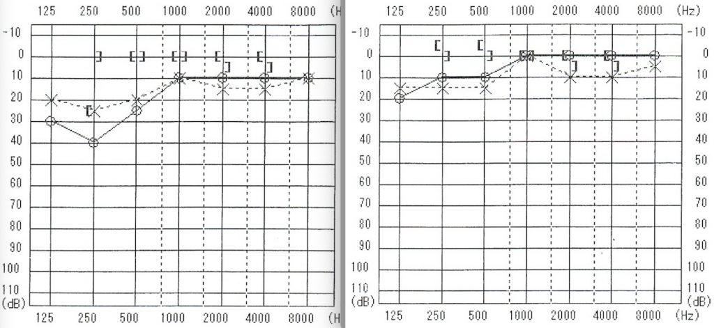 突発性難聴,京都市,TA